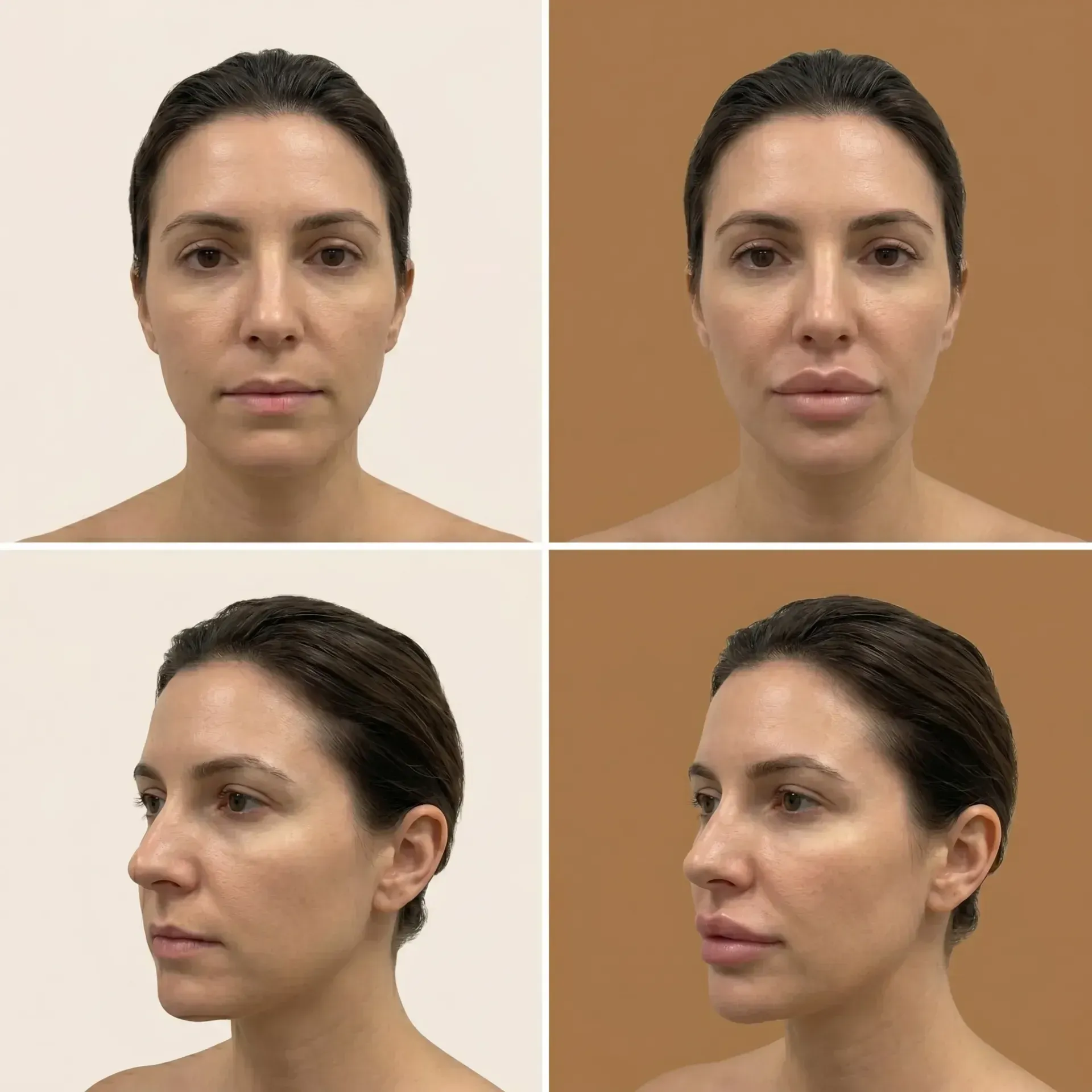 Lip Lift