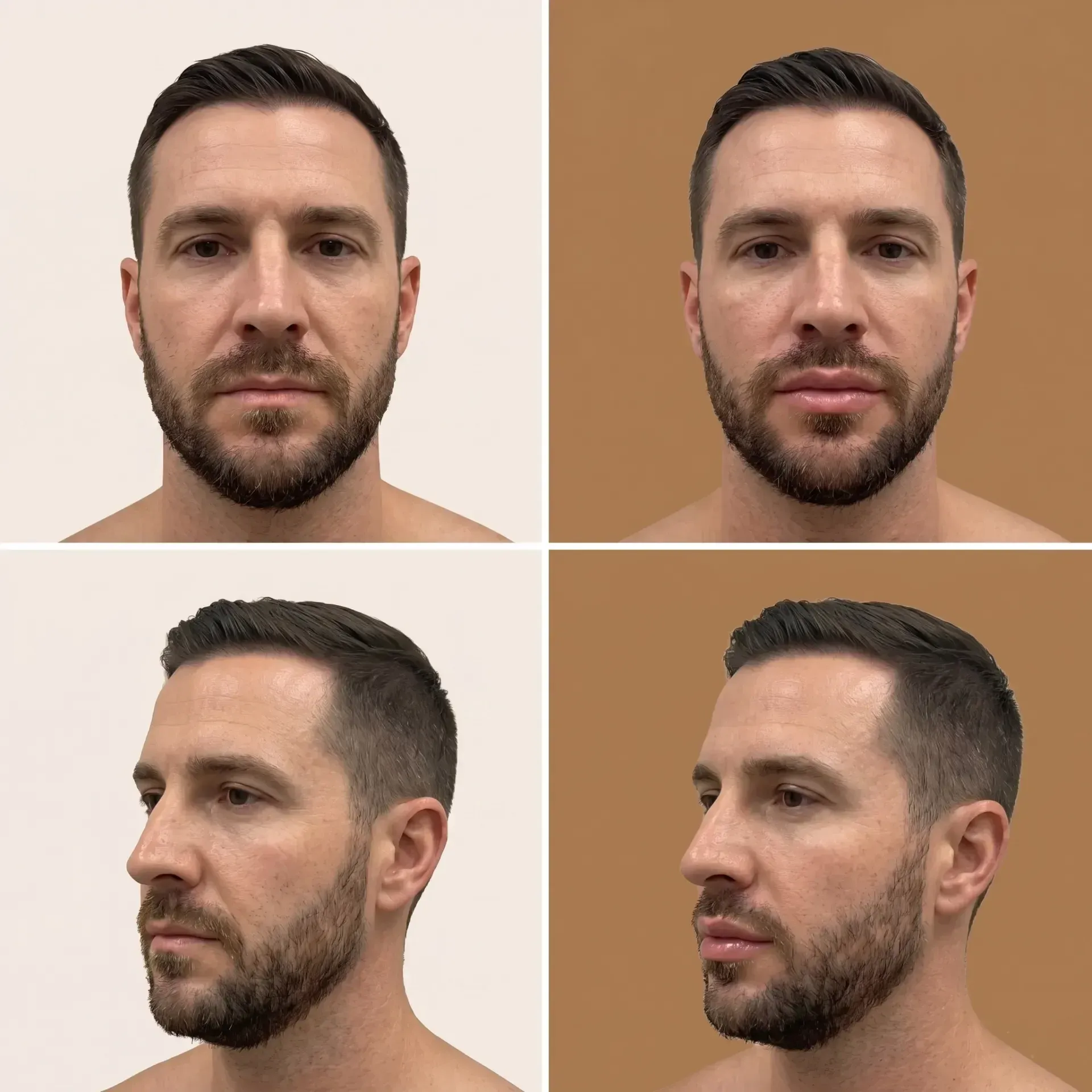 Lip Lift