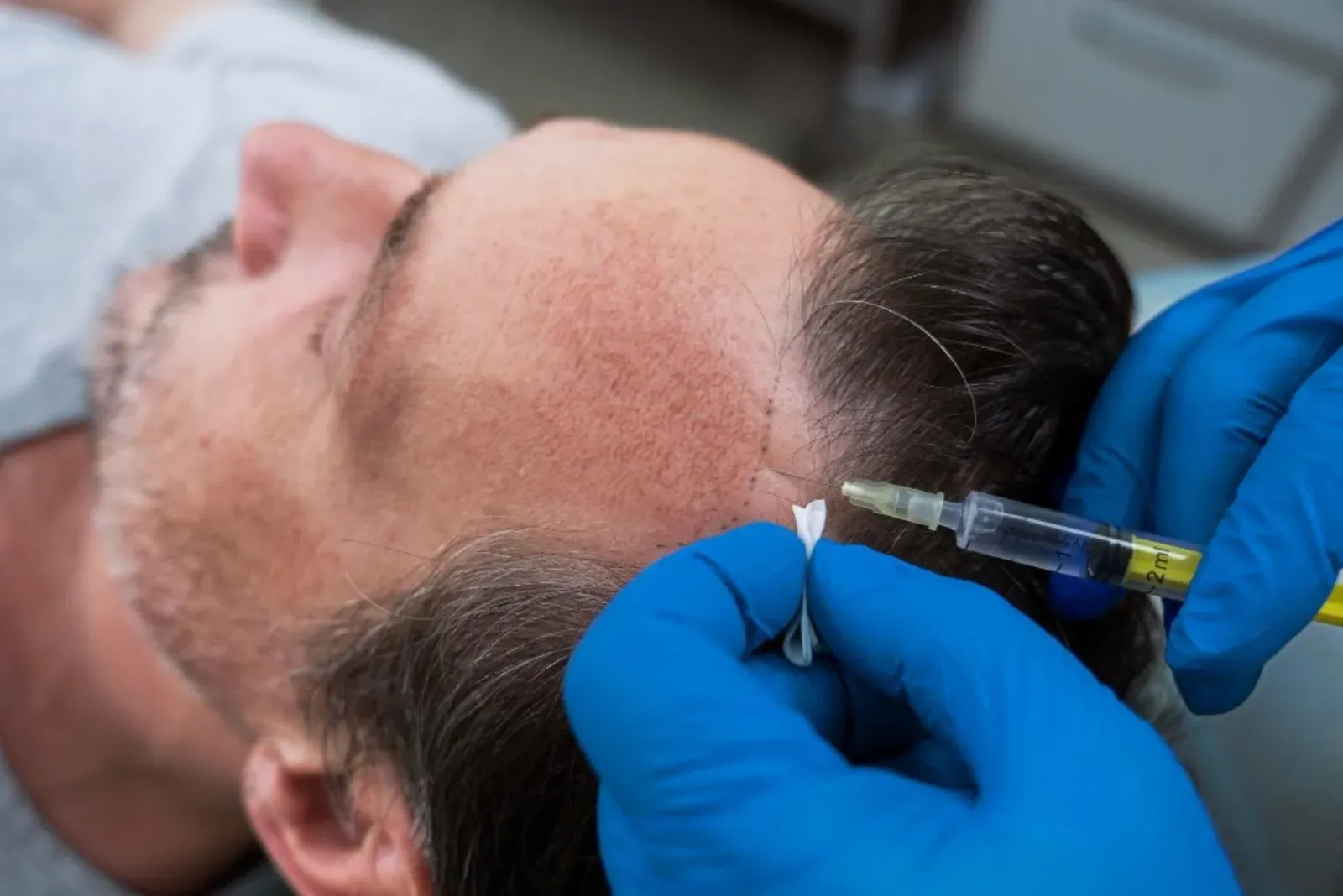 Which One is Better: Hair Transplant or Hair Loss Treatments?